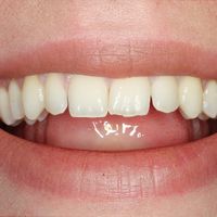 Edge Bonding - Smile 2 before